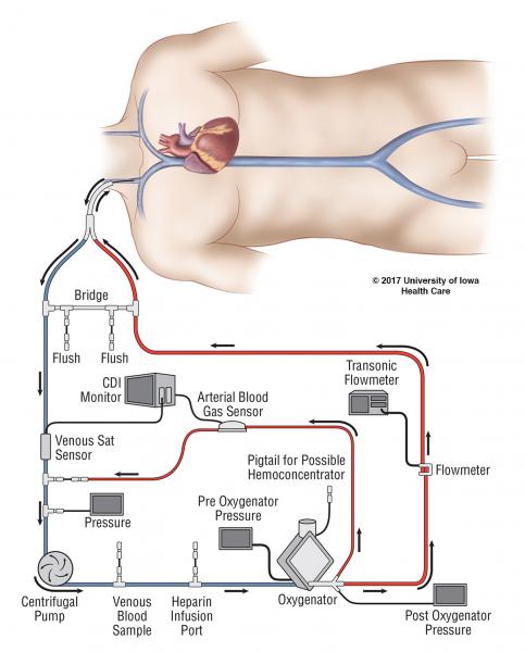 ecmo figure2